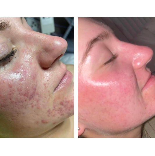 Kiwi Spa Esthetician performing a facial treatment for acne 