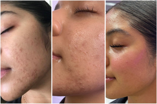 Acne Facials at Kiwi Spa